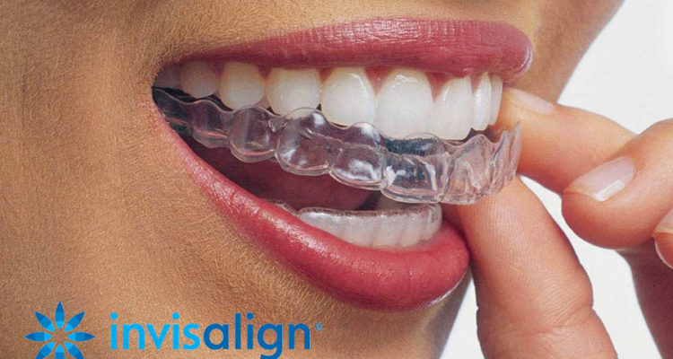 Clear Aligners